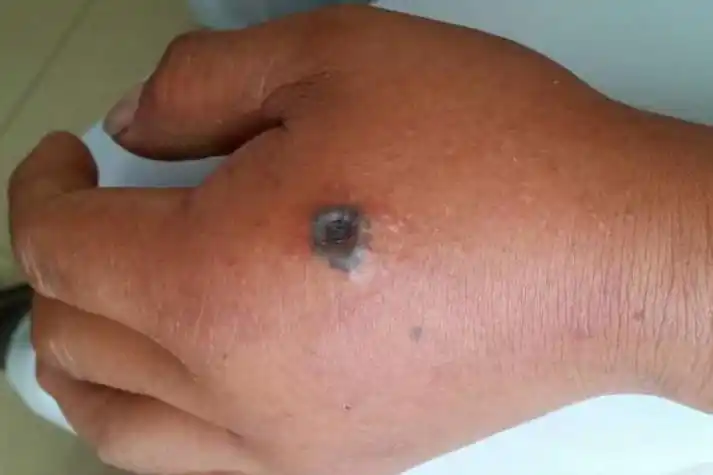 人体皮肤炭疽病图片_互联健康