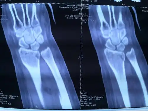 "令人感动的桡骨远端骨折复位"后续