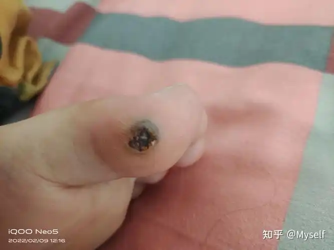 记录我的激光去疣