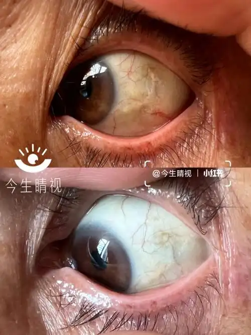 15分钟睑裂斑修复效果展示