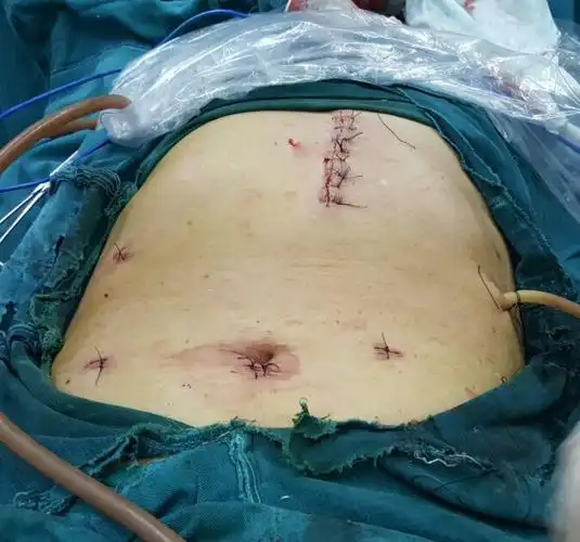 其它 外一科腹腔镜手术系列——胃癌根治术 写美篇 科普胃癌手术:胃癌