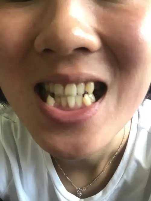 分享我与牙套君相处的日子 我是有虎牙的人,下牙真的是扭曲到爆00