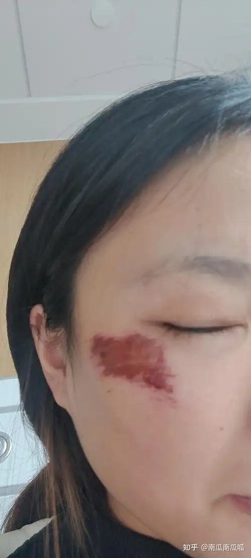 脸部擦伤恢复过程