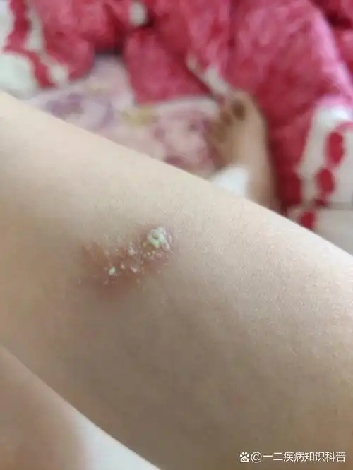 (图慎点)被隐翅虫咬了 前几天胳膊上有一个小红点点,还没图1,2大,比较