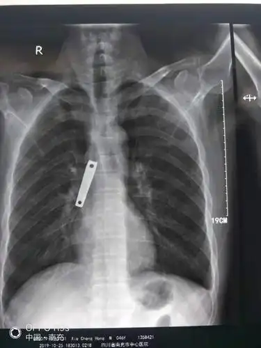 吞下异物误入肺呼吸内镜显神威