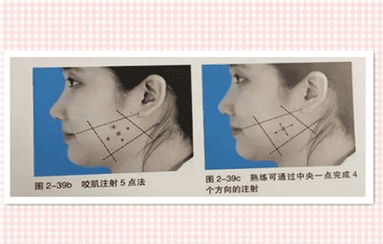 瘦脸针的打法最全的肉毒素注射方法你都知道吗