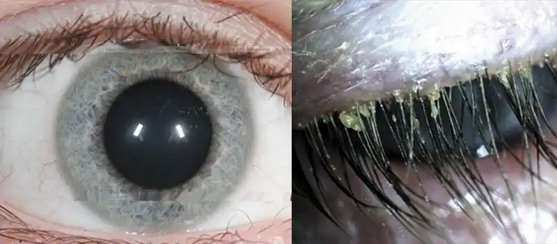 不要小看「倒睫毛」! 随便揉,随便拔都有危险!你应该选择这样处理它!