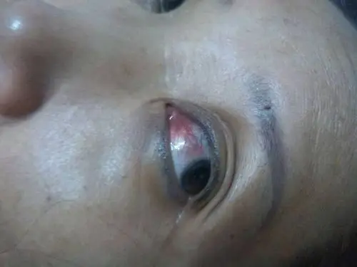 母亲左眼白充血,好多链状血丝,有轻微胀痛感,怎么回事?