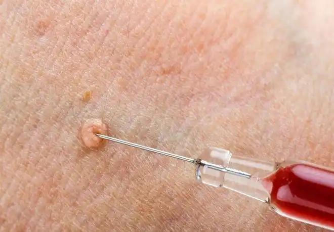 脖子上的小揪揪别拔,当心是hpv感染,越拔越多|丝状疣|皮损|乳头瘤