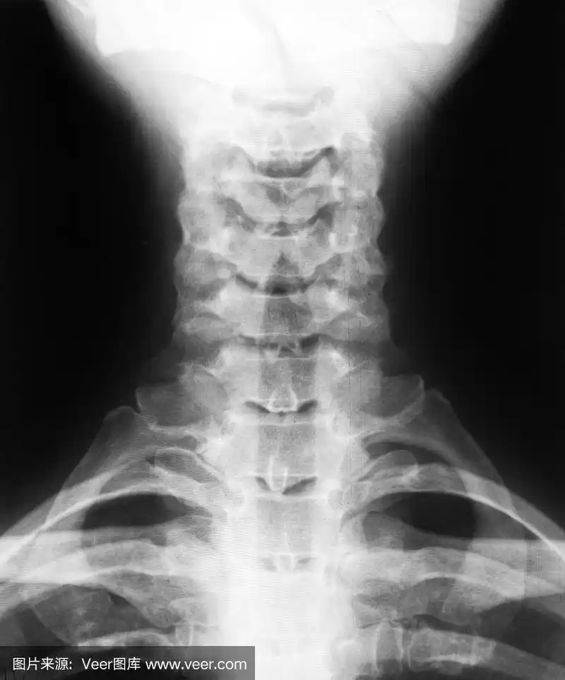 颈椎x线照片
