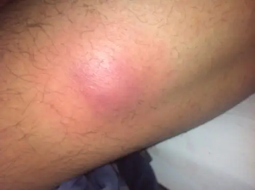 皮肤性病科 皮肤科 → 腿上肿了一块,发红很痛以前没有过就这两三&