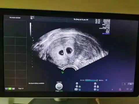 双卵双胞胎是不是龙凤胎几率很大,这个是今天的b超图怀孕50来天!