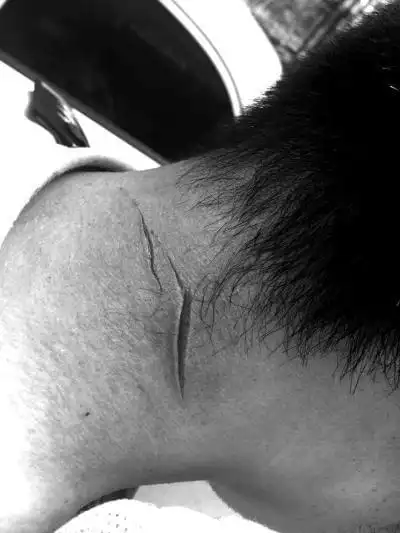 民警后脖颈被割出两道伤口.海淀警方供图