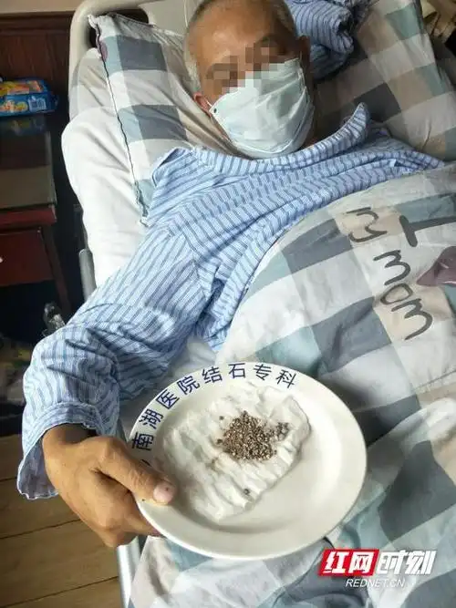 龙丰)来自浏阳的瞿先生今年51岁,近期因肾脏结石在长沙南湖医院结石