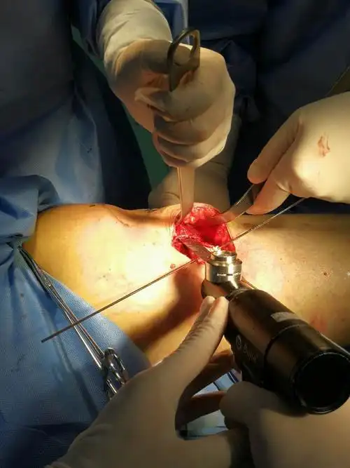 平台下截骨,植骨,hto锁钉板内固定术治疗骨性关节炎.(保膝关节治疗)