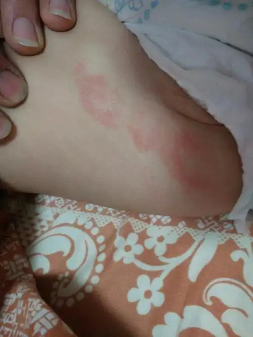 宝宝一直用的花王尿不湿用的很好的但是不知道怎么回事突然冒出了湿疹