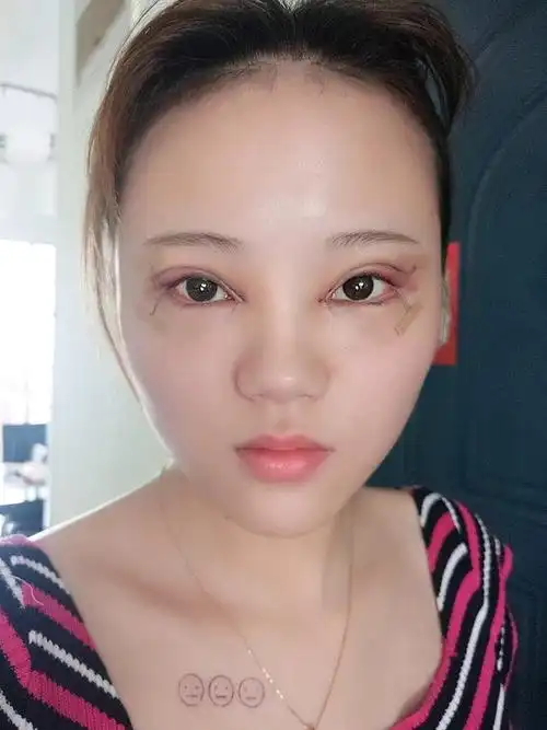 双眼皮7mm 眼睑下至2mm 内外眼角全开 图片分别为第一天晚上 第二天