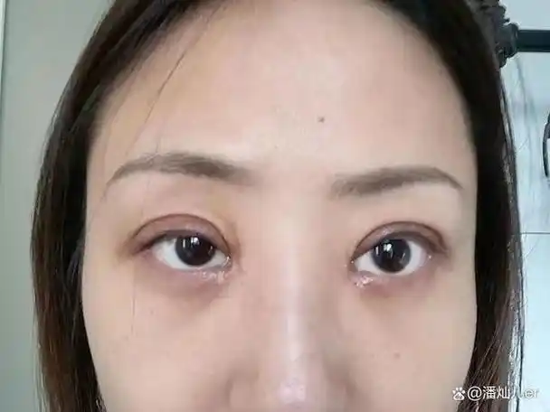 内眼角开大了修复案例
