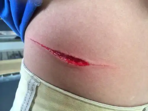 这个伤口不处理可以么?