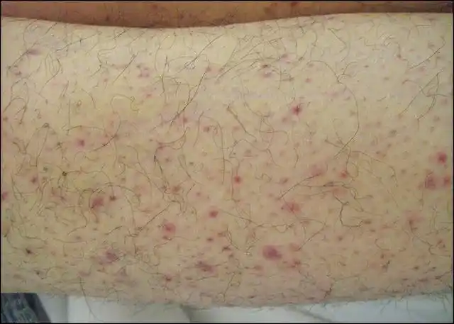 身上无缘无故出现淤青怎么办