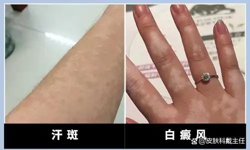 夏季很常见的白斑,汗斑,它可不是白癜风,大家别再分不清了