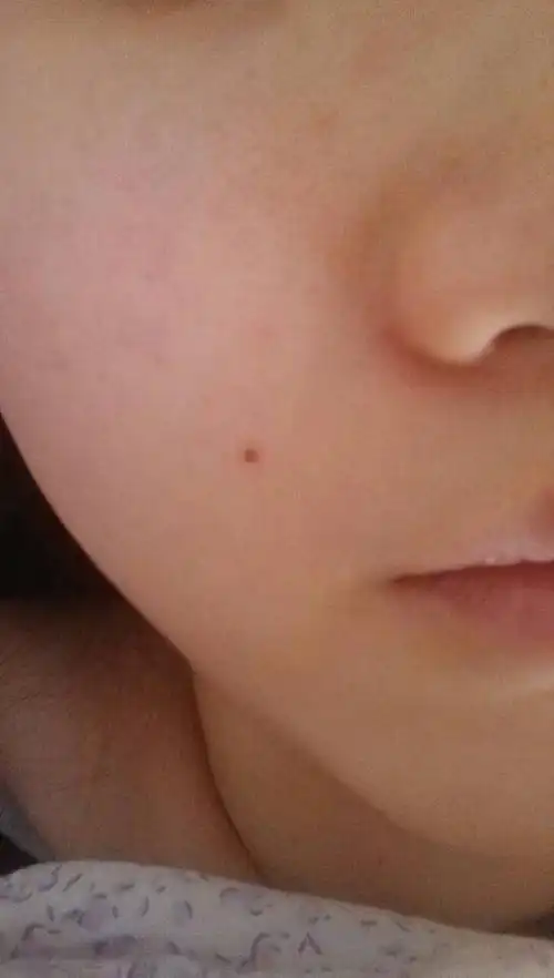 药水点痣结的痂掉了一个,但是变成一个黑红色的坑,可以长好吗?