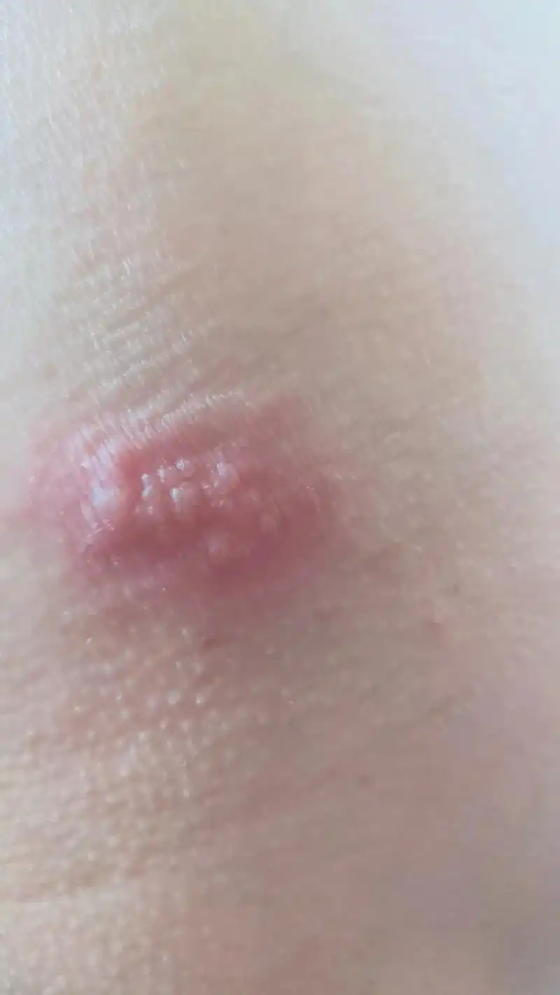 去了一次海边回来无缘无故腿部长蛇缠腰疼的都走不了路01. - 抖音