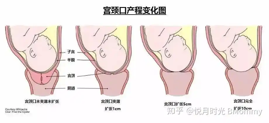 推到子宫颈,从而促进扩张,当真正宫缩来临时,宫缩会促进宫颈管变短,也