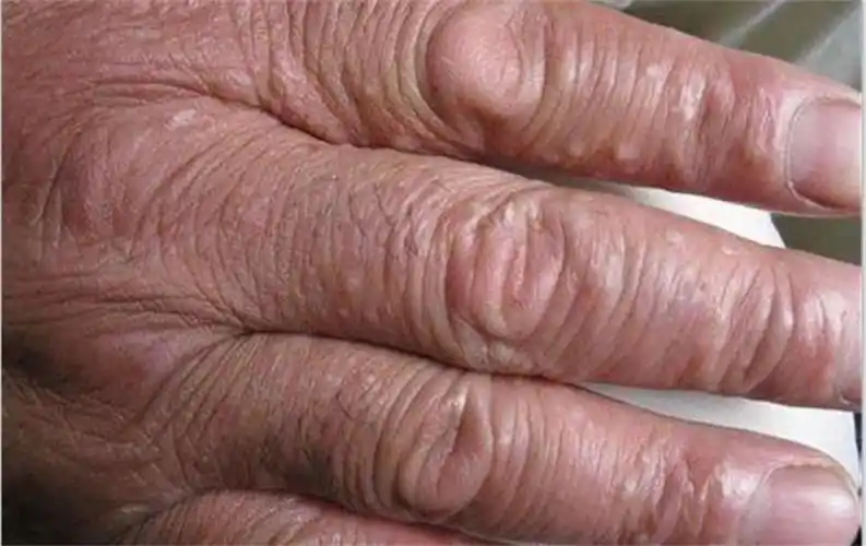 天津手癣专家_天津治疗手癣哪个专家好_天津治疗手癣最好的专家/排行