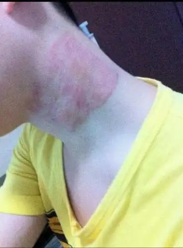 特禀体质是什么?就是人非常容易过敏,这一点非常容易掌握