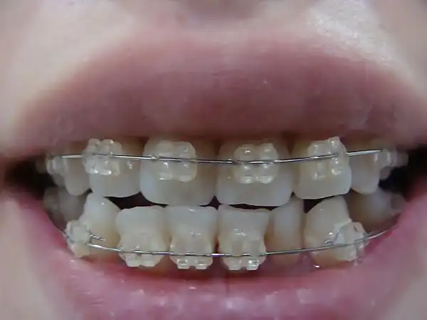 xixi的相册-牙套