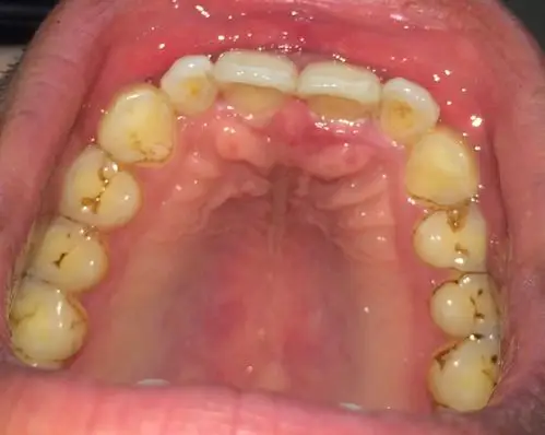 口腔上颚门牙位置感觉不舒服,是什么原因