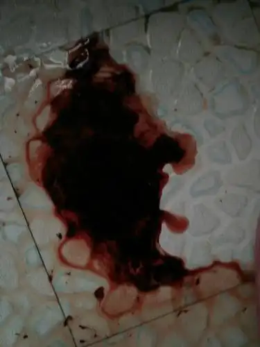 产后第一次月经量多,如图,一天5.6次那样多,身体很乏