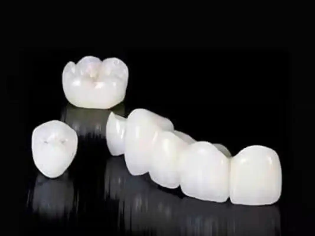 它采用与牙齿颜色相近的高强度瓷材料制成,较金属基底烤瓷修复体更