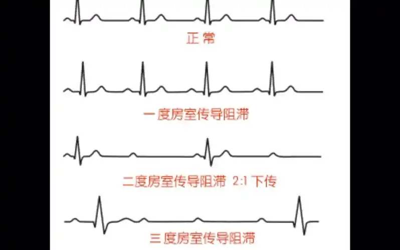 房室传导阻滞之离婚三部曲 回家的诱惑