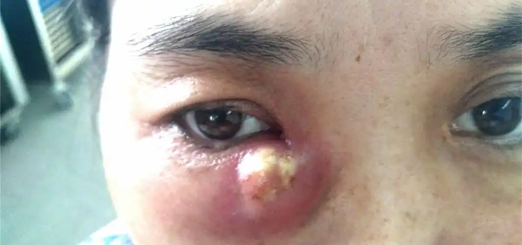 泪眼婆娑一余年半月内眼角又胀起脓包慢性泪囊炎冲刺发作吓坏六旬阿姨