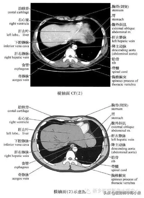 「腹部ct断层解剖」腹部ct扫描横断位解剖 详细标注,值得收藏