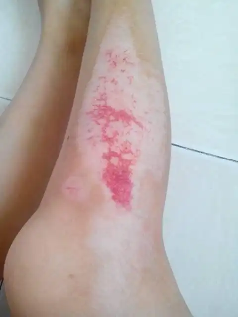 小腿大面积擦伤,出车祸伤的,,现在已经有一个月了!会不会留疤.