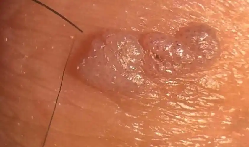 尖锐湿疣早期症状图片