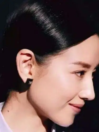 颜值杀手鼻基底凹陷