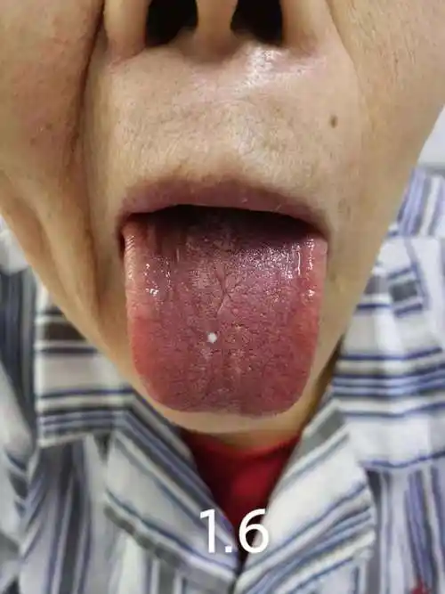 白细胞26.9×109/l,怎样使用抗生素?本例患者:不用!