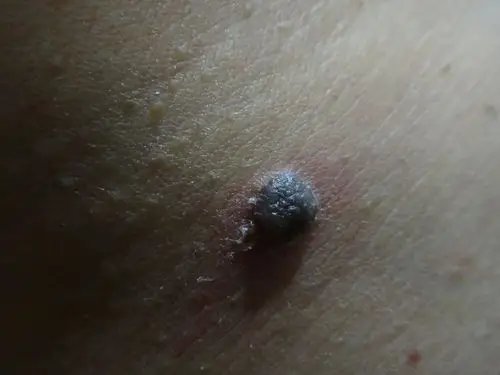 我脖子上的痦子总是脱皮,使黑色素瘤吗