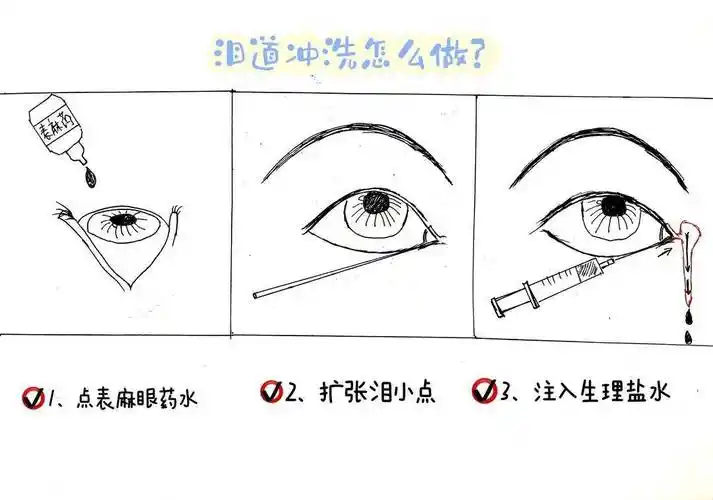 眼科:白内障术前泪道冲洗不用怕!_患者_手术_进行