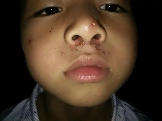 孩子这鼻子是什么病
