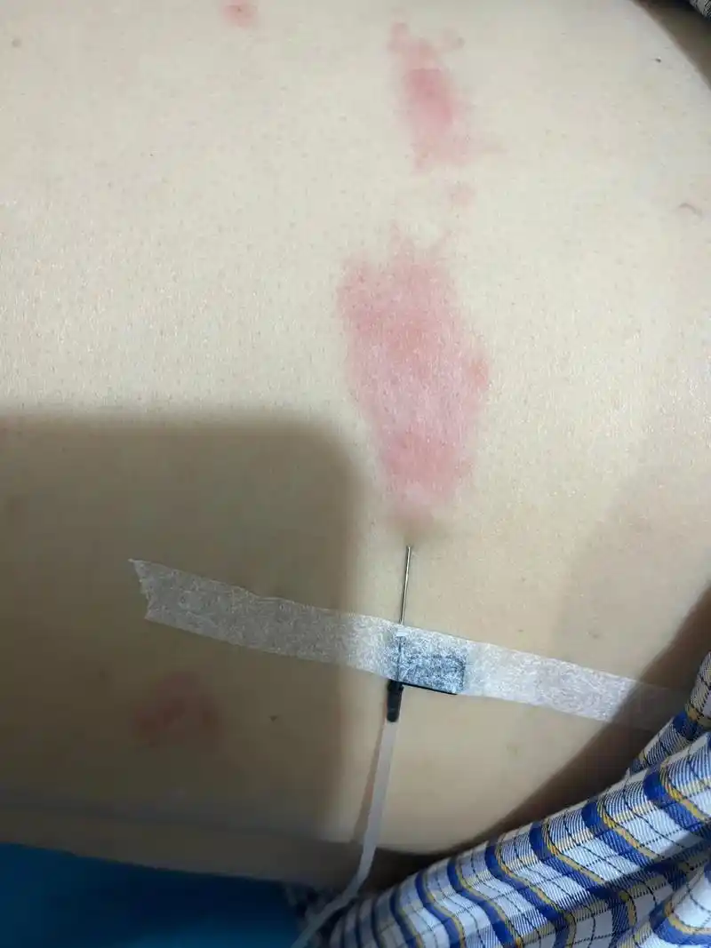 隔30年再次得带状疱疹#飞蛇#带状疱疹 - 抖音