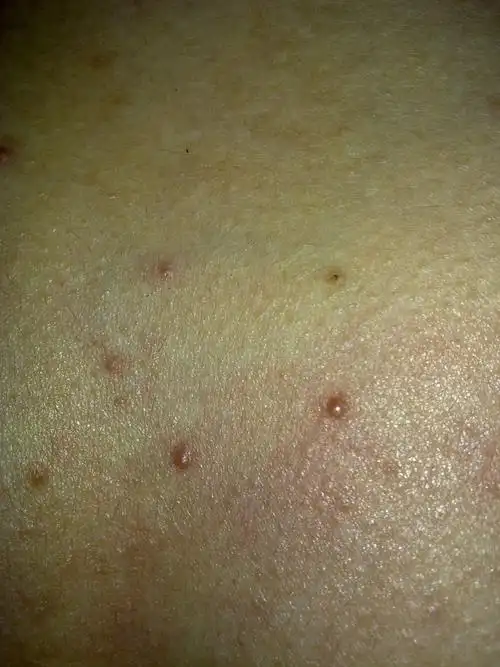 胸口上老长一些痘痘,是怎么回事