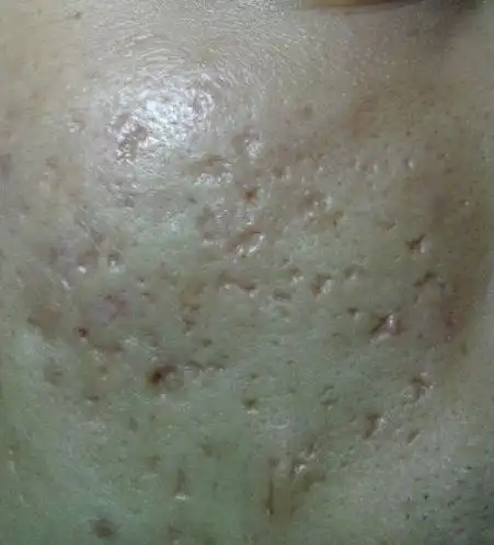 怎样祛除痘印痘疤