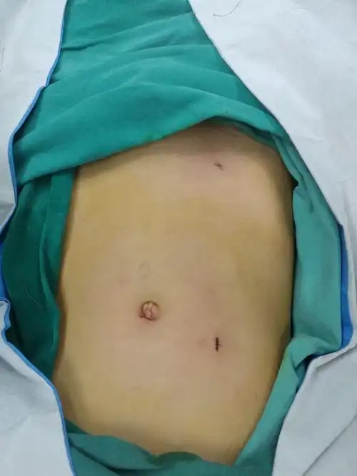 腹腔镜腹膜鞘突高位结扎术