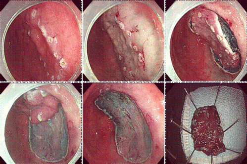 胃癌早期可以治愈好么?