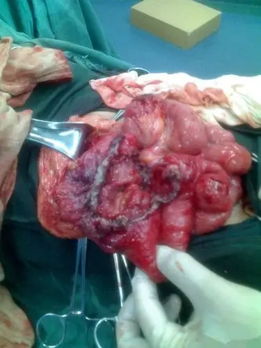 初期肛瘘什么症状图片_有来医生